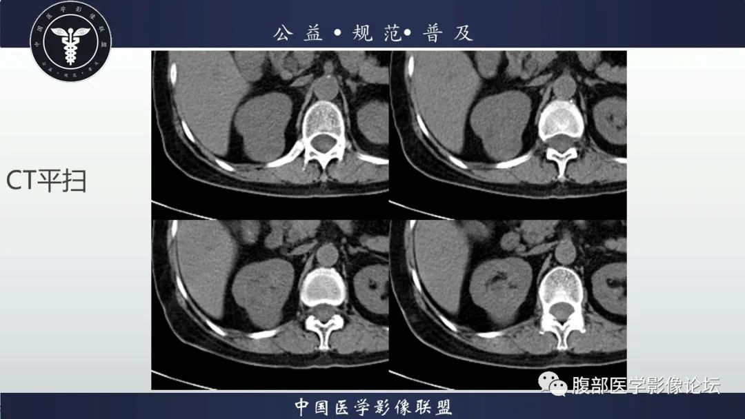 【病例】肾脏乳头状肾细胞癌1例CT及MR影像讨论 【病例】肾脏乳头状肾细胞癌1例CT及MR影像讨论