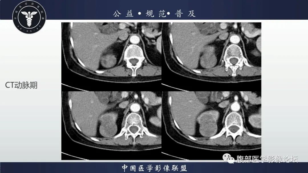 【病例】肾脏乳头状肾细胞癌1例CT及MR影像讨论 【病例】肾脏乳头状肾细胞癌1例CT及MR影像讨论