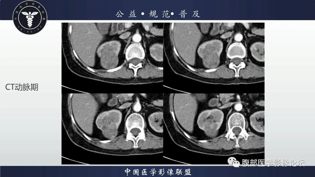 【病例】肾脏乳头状肾细胞癌1例CT及MR影像讨论 【病例】肾脏乳头状肾细胞癌1例CT及MR影像讨论