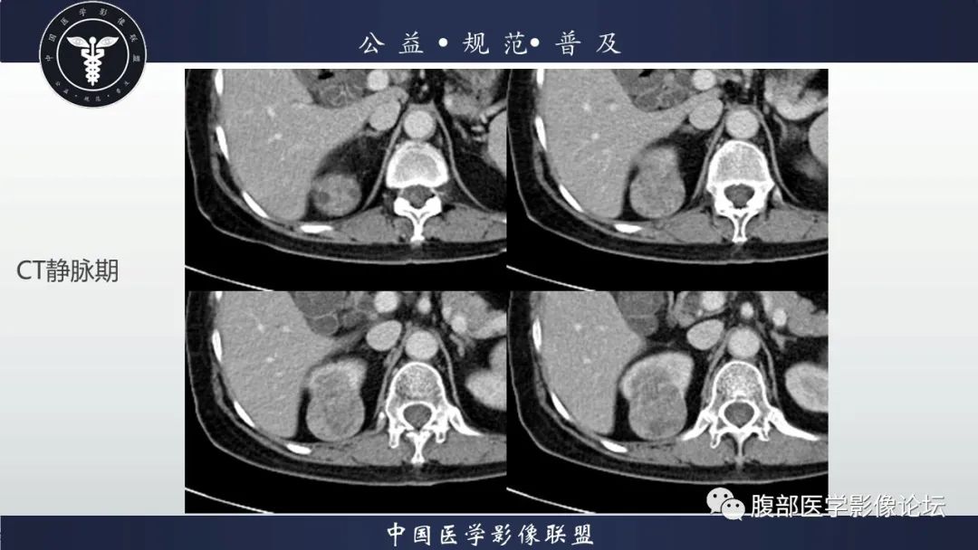 【病例】肾脏乳头状肾细胞癌1例CT及MR影像讨论 【病例】肾脏乳头状肾细胞癌1例CT及MR影像讨论
