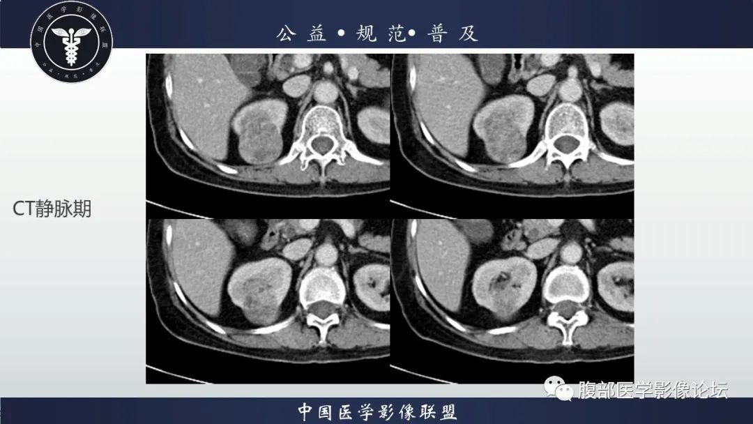 【病例】肾脏乳头状肾细胞癌1例CT及MR影像讨论 【病例】肾脏乳头状肾细胞癌1例CT及MR影像讨论