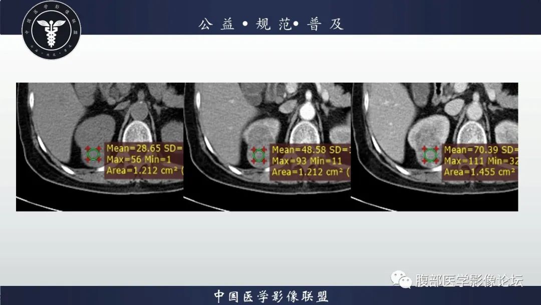 【病例】肾脏乳头状肾细胞癌1例CT及MR影像讨论 【病例】肾脏乳头状肾细胞癌1例CT及MR影像讨论
