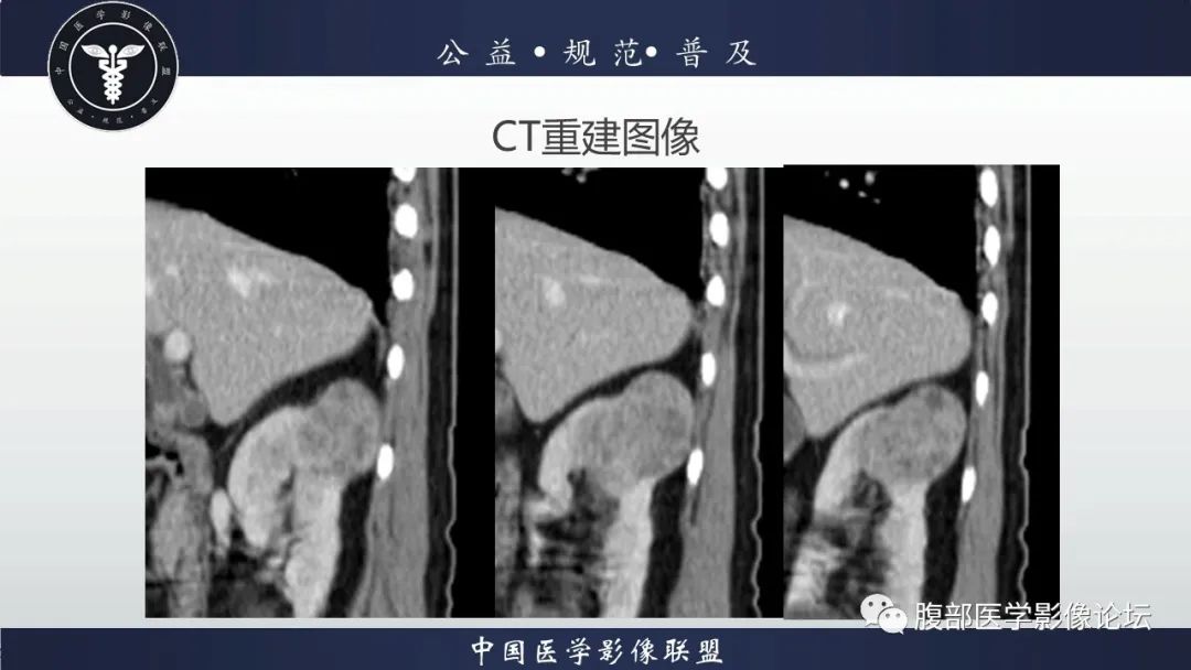 【病例】肾脏乳头状肾细胞癌1例CT及MR影像讨论 【病例】肾脏乳头状肾细胞癌1例CT及MR影像讨论