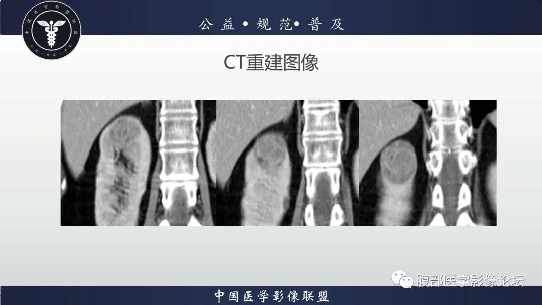 【病例】肾脏乳头状肾细胞癌1例CT及MR影像讨论 【病例】肾脏乳头状肾细胞癌1例CT及MR影像讨论