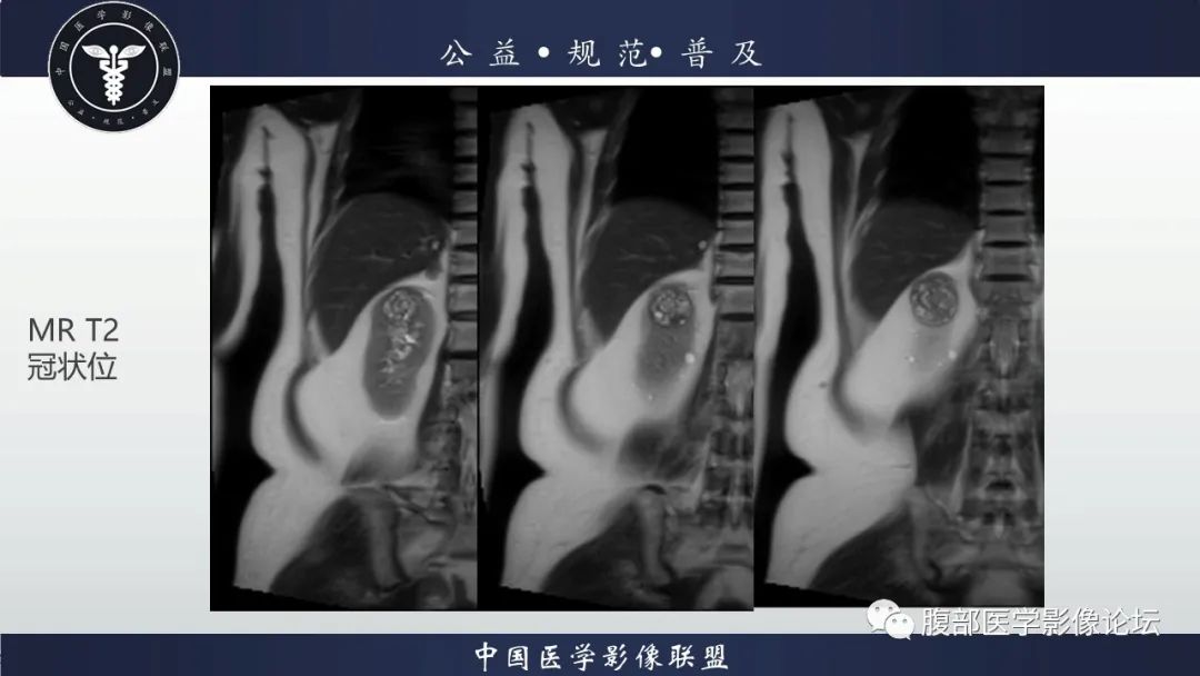 【病例】肾脏乳头状肾细胞癌1例CT及MR影像讨论 【病例】肾脏乳头状肾细胞癌1例CT及MR影像讨论