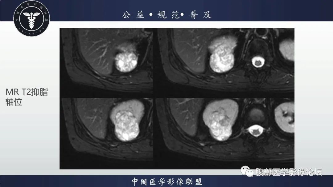 【病例】肾脏乳头状肾细胞癌1例CT及MR影像讨论 【病例】肾脏乳头状肾细胞癌1例CT及MR影像讨论