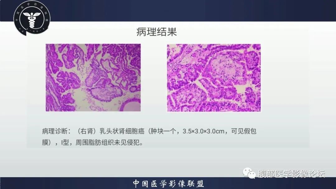 【病例】肾脏乳头状肾细胞癌1例CT及MR影像讨论 【病例】肾脏乳头状肾细胞癌1例CT及MR影像讨论