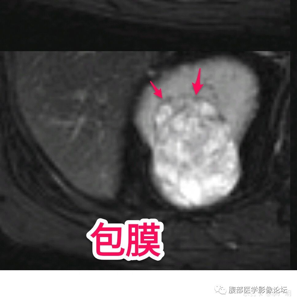 【病例】肾脏乳头状肾细胞癌1例CT及MR影像讨论 【病例】肾脏乳头状肾细胞癌1例CT及MR影像讨论