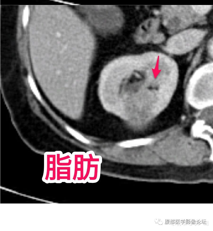 【病例】肾脏乳头状肾细胞癌1例CT及MR影像讨论