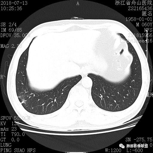 【病例】肺隐球菌病1例CT影像 【病例】肺隐球菌病1例CT影像