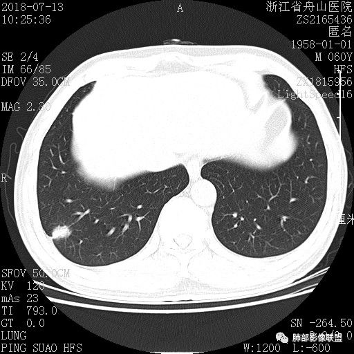 【病例】肺隐球菌病1例CT影像 【病例】肺隐球菌病1例CT影像