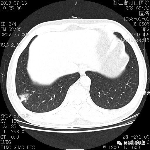 【病例】肺隐球菌病1例CT影像 【病例】肺隐球菌病1例CT影像