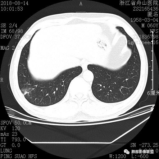 【病例】肺隐球菌病1例CT影像 【病例】肺隐球菌病1例CT影像
