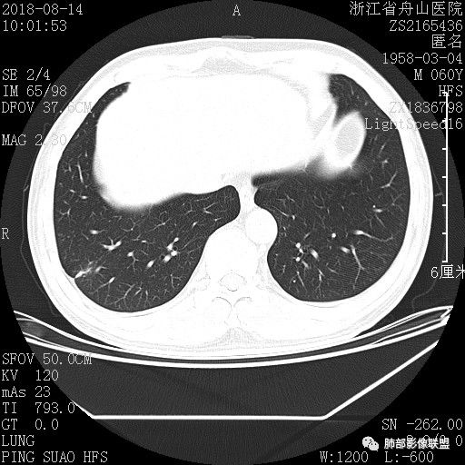 【病例】肺隐球菌病1例CT影像 【病例】肺隐球菌病1例CT影像