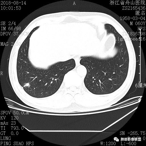 【病例】肺隐球菌病1例CT影像 【病例】肺隐球菌病1例CT影像