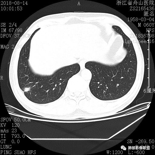 【病例】肺隐球菌病1例CT影像 【病例】肺隐球菌病1例CT影像