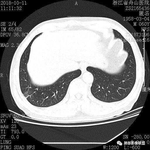 【病例】肺隐球菌病1例CT影像 【病例】肺隐球菌病1例CT影像
