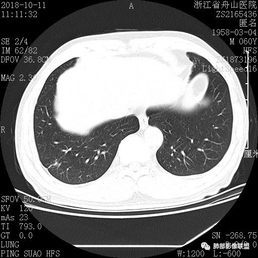 【病例】肺隐球菌病1例CT影像 【病例】肺隐球菌病1例CT影像