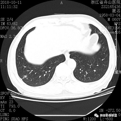 【病例】肺隐球菌病1例CT影像 【病例】肺隐球菌病1例CT影像