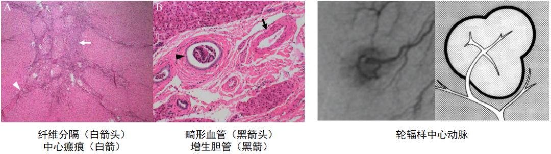 肝脏局灶性结节增生 「FNH」 影像特点 肝脏局灶性结节增生 「FNH」 影像特点