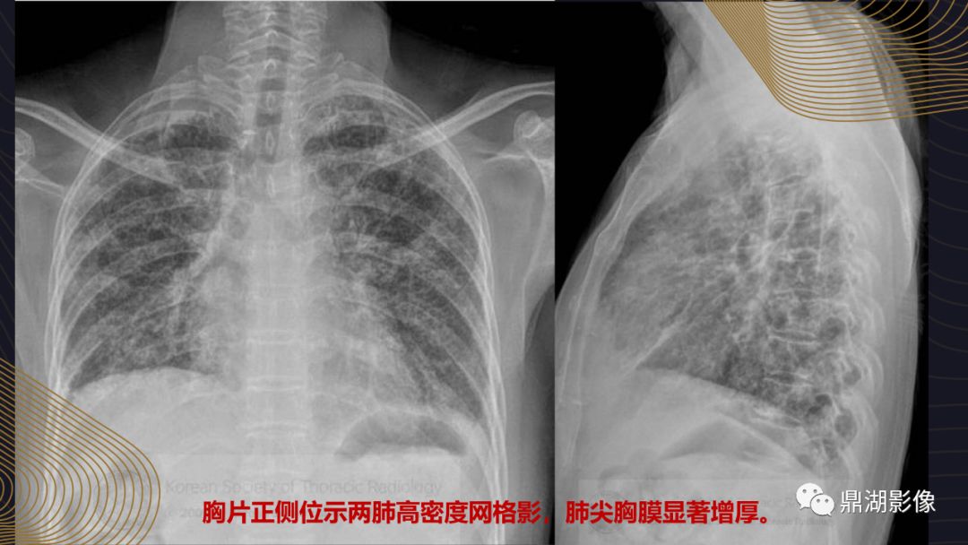 【病例】胸膜肺实质弹力纤维增生症1例CT影像 【病例】胸膜肺实质弹力纤维增生症1例CT影像