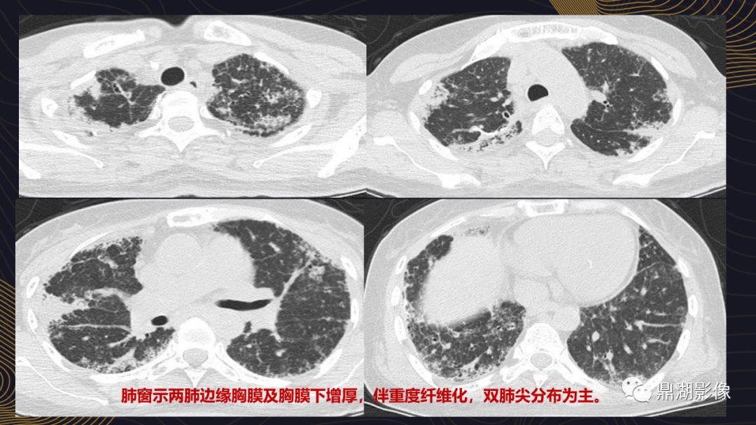 【病例】胸膜肺实质弹力纤维增生症1例CT影像 【病例】胸膜肺实质弹力纤维增生症1例CT影像