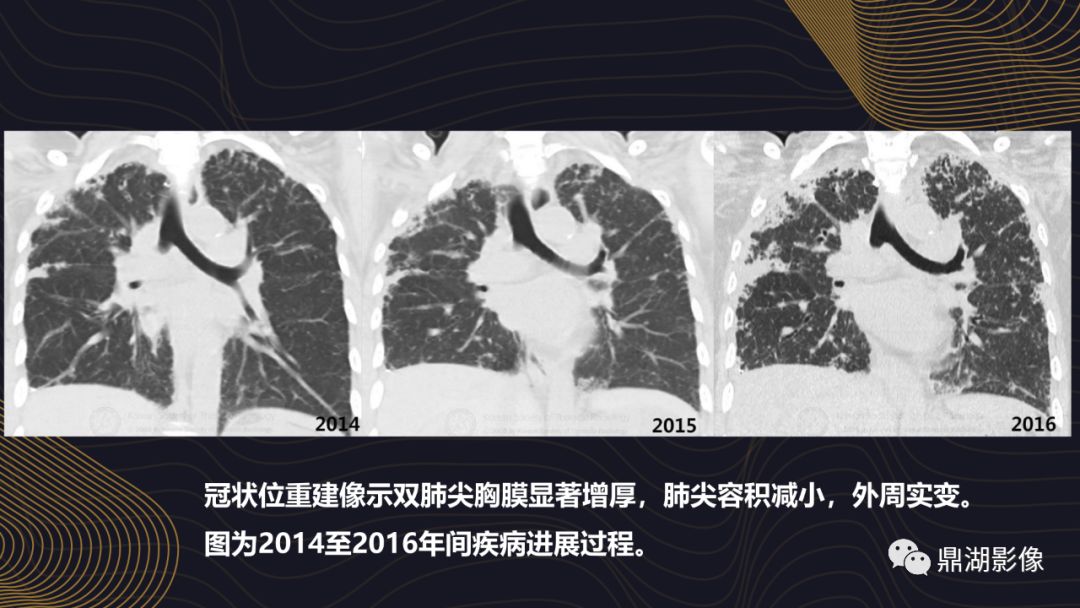 【病例】胸膜肺实质弹力纤维增生症1例CT影像 【病例】胸膜肺实质弹力纤维增生症1例CT影像