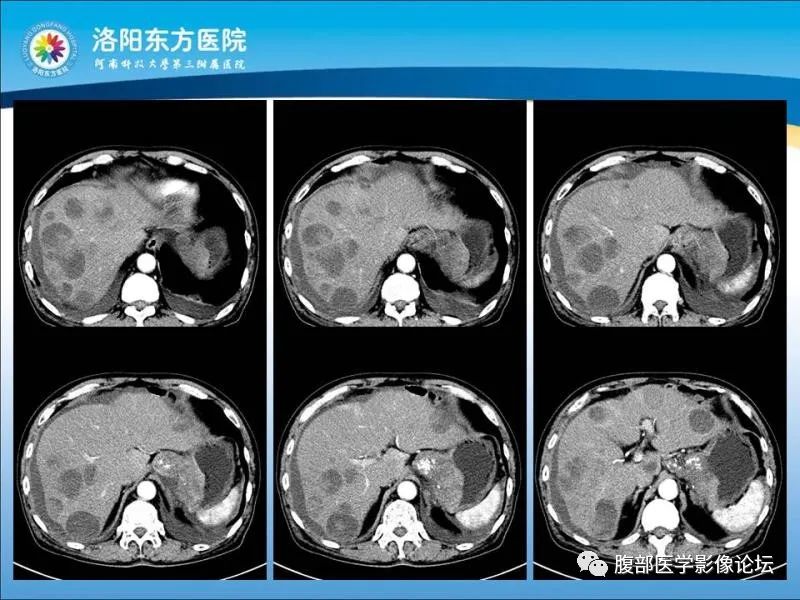【病例】胃肝样腺癌肝内多发转移1例CT影像