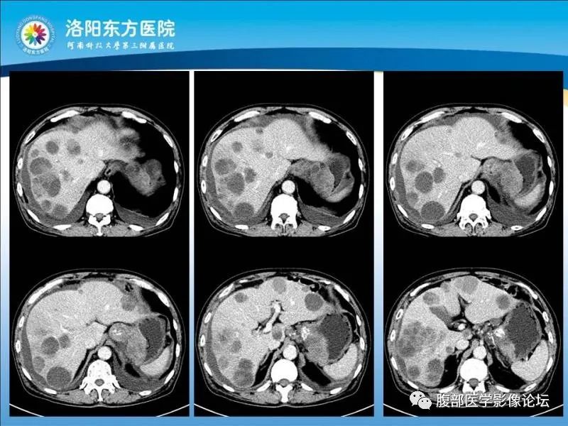 【病例】胃肝样腺癌肝内多发转移1例CT影像