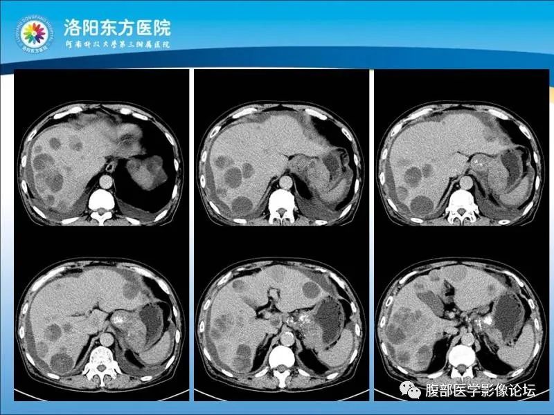 【病例】胃肝样腺癌肝内多发转移1例CT影像