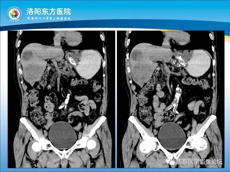 【病例】胃肝样腺癌肝内多发转移1例CT影像