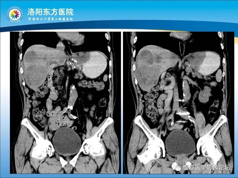 【病例】胃肝样腺癌肝内多发转移1例CT影像