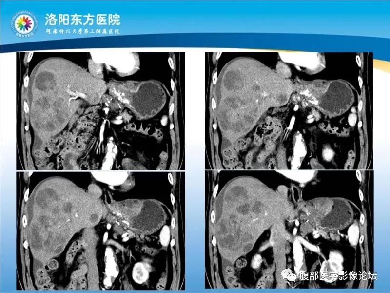 【病例】胃肝样腺癌肝内多发转移1例CT影像