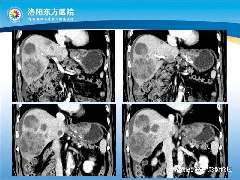 【病例】胃肝样腺癌肝内多发转移1例CT影像