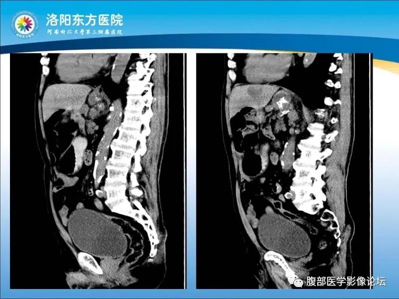 【病例】胃肝样腺癌肝内多发转移1例CT影像