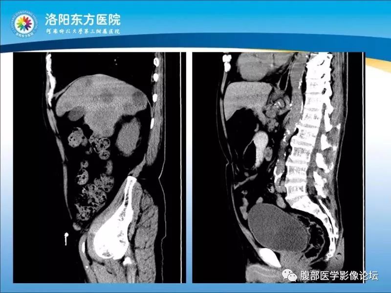 【病例】胃肝样腺癌肝内多发转移1例CT影像