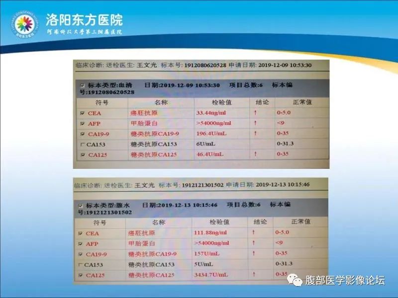 【病例】胃肝样腺癌肝内多发转移1例CT影像