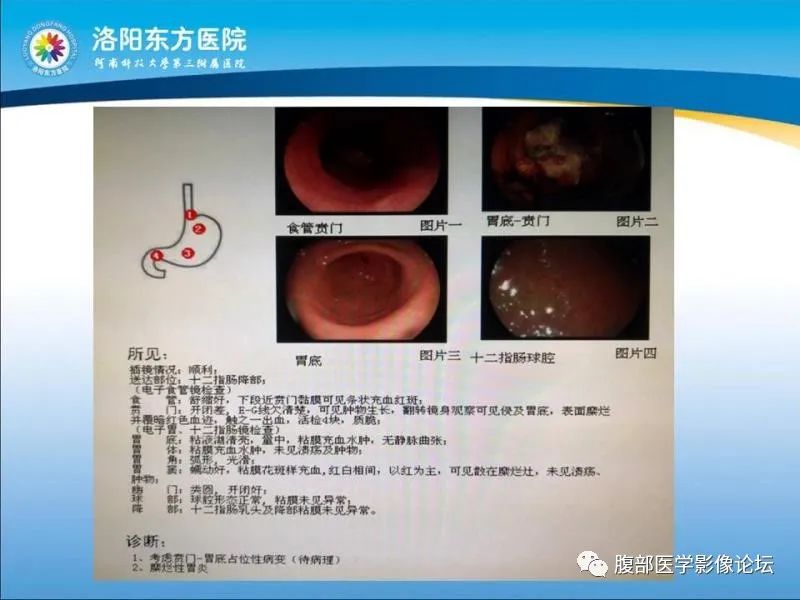 【病例】胃肝样腺癌肝内多发转移1例CT影像
