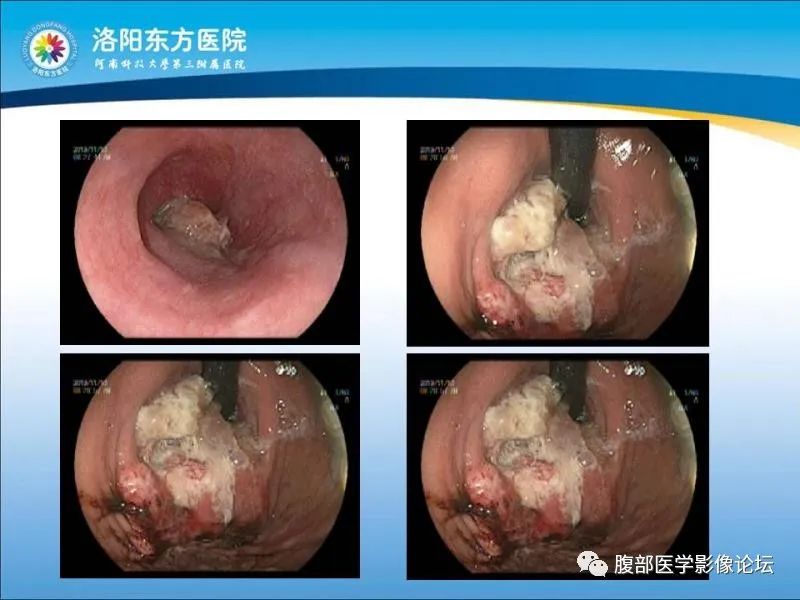 【病例】胃肝样腺癌肝内多发转移1例CT影像