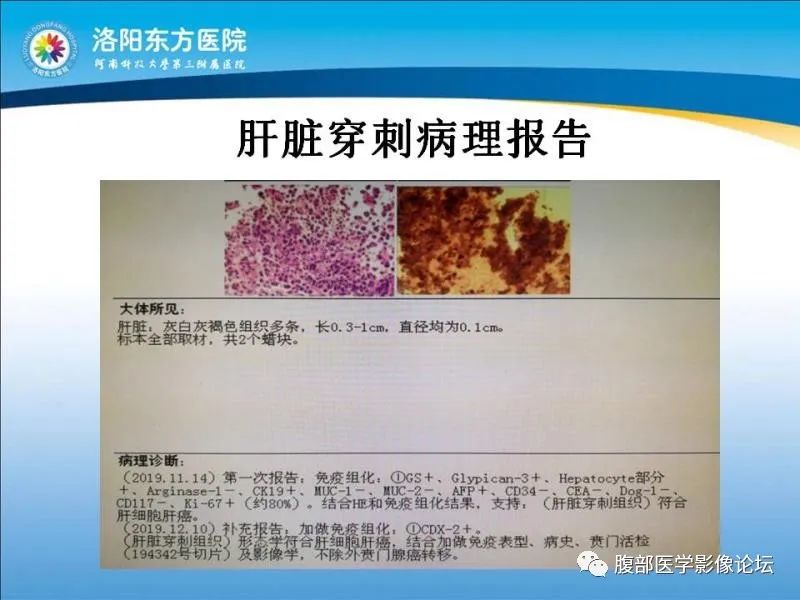 【病例】胃肝样腺癌肝内多发转移1例CT影像
