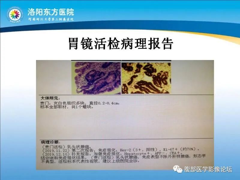 【病例】胃肝样腺癌肝内多发转移1例CT影像