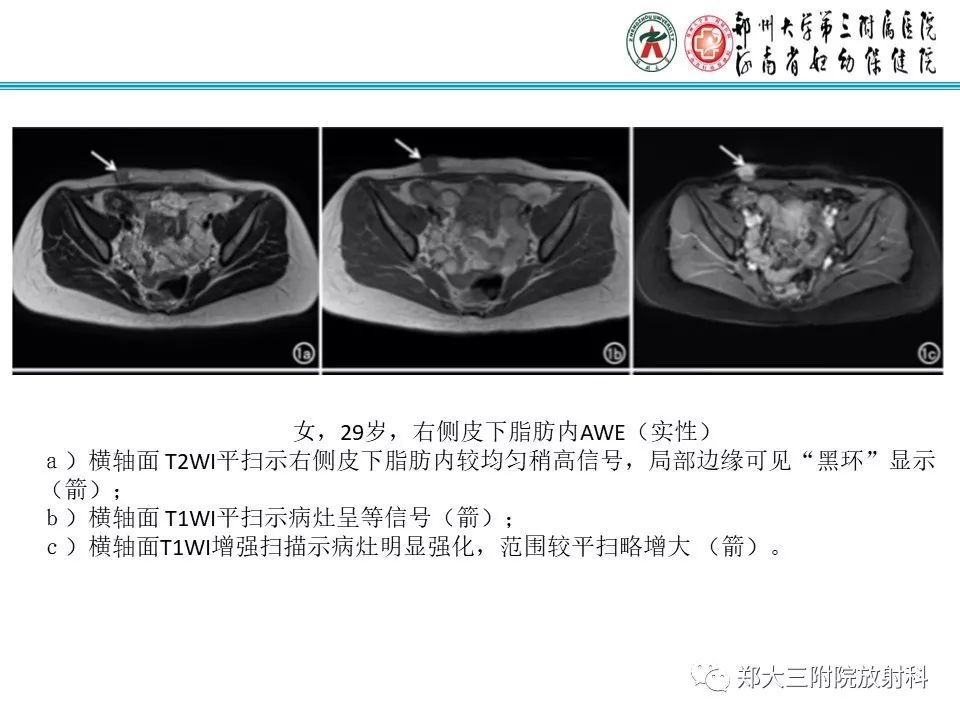 【PPT】腹壁子宫内膜异位症