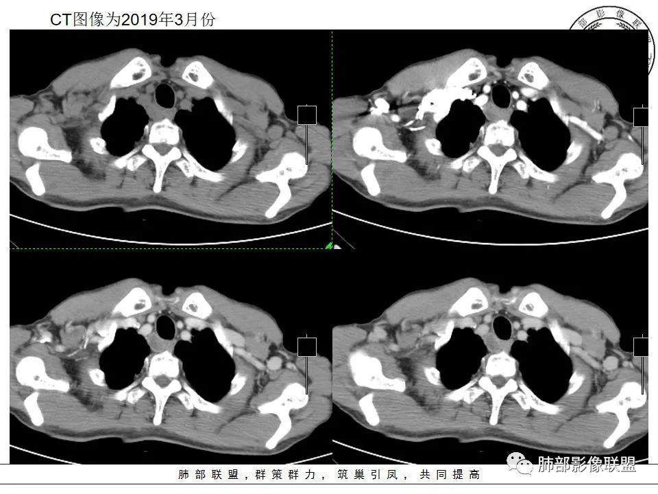 【病例】肺不典型类癌1例CT影像讨论 【病例】肺不典型类癌1例CT影像讨论