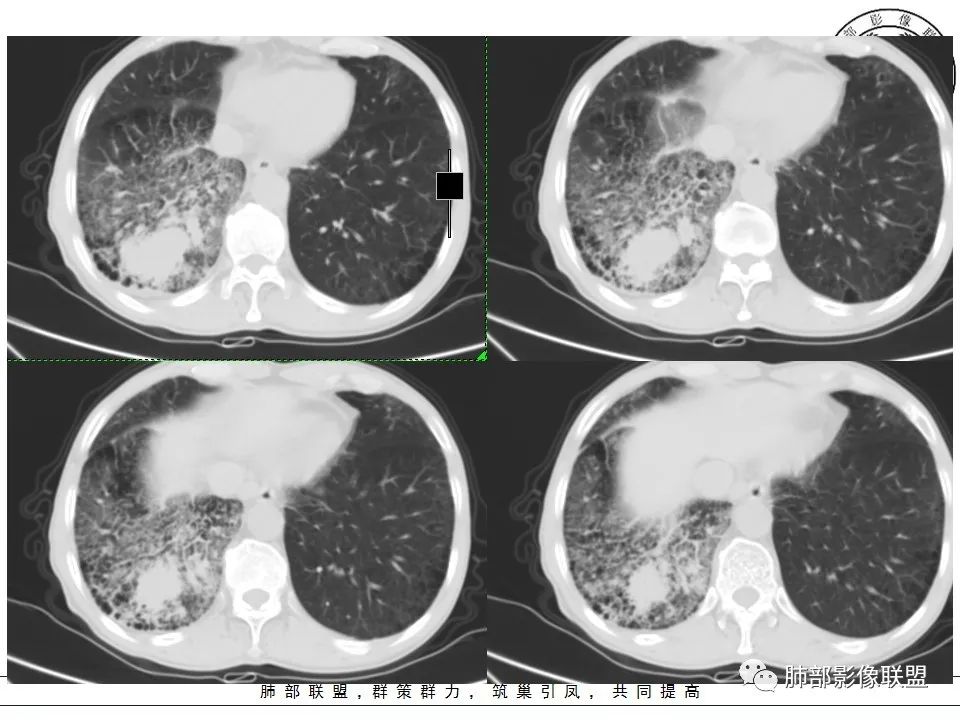 【病例】肺不典型类癌1例CT影像讨论 【病例】肺不典型类癌1例CT影像讨论