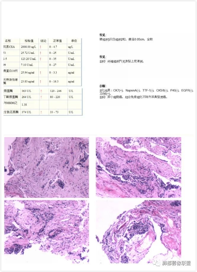 【病例】肺不典型类癌1例CT影像讨论 【病例】肺不典型类癌1例CT影像讨论