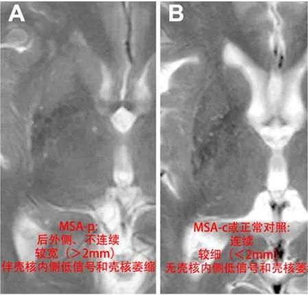 帕金森病和帕金森综合征的影像 帕金森病和帕金森综合征的影像