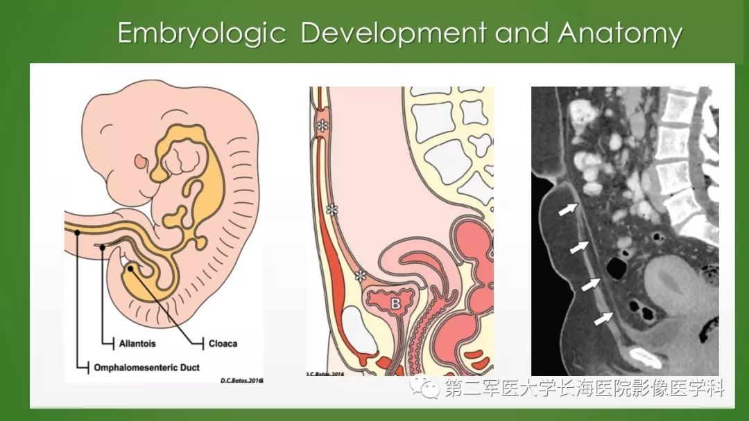 【PPT】脐尿管异常的影像表现与临床