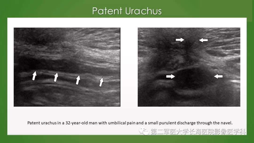 【PPT】脐尿管异常的影像表现与临床