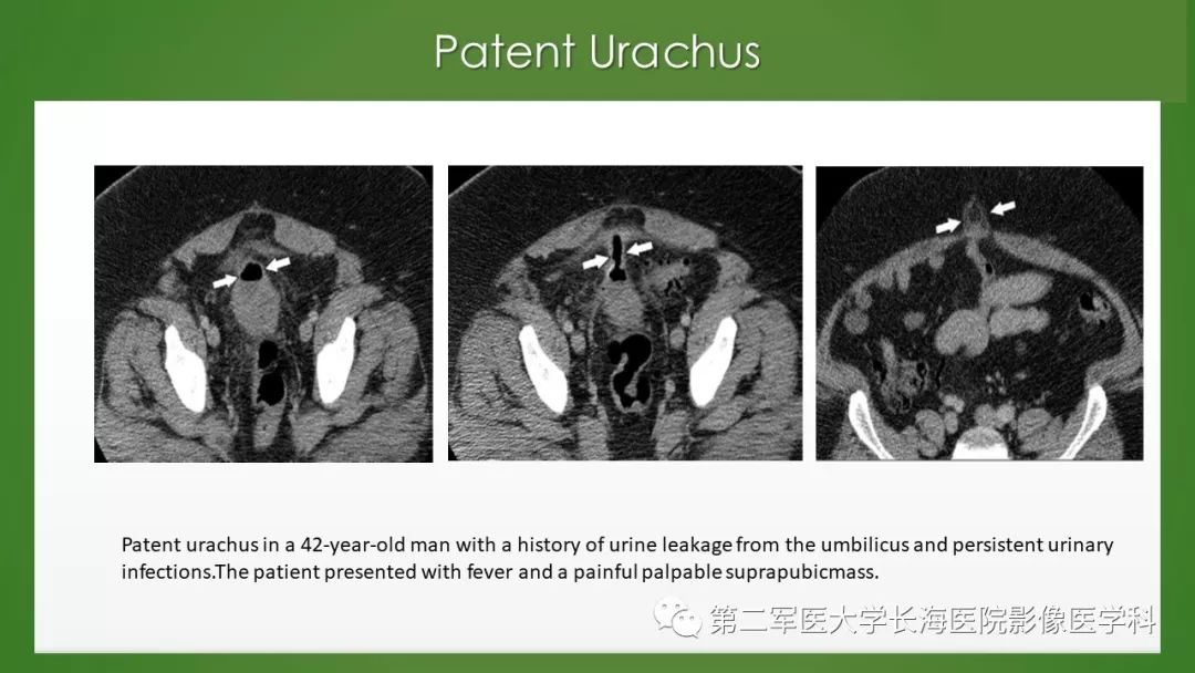 【PPT】脐尿管异常的影像表现与临床