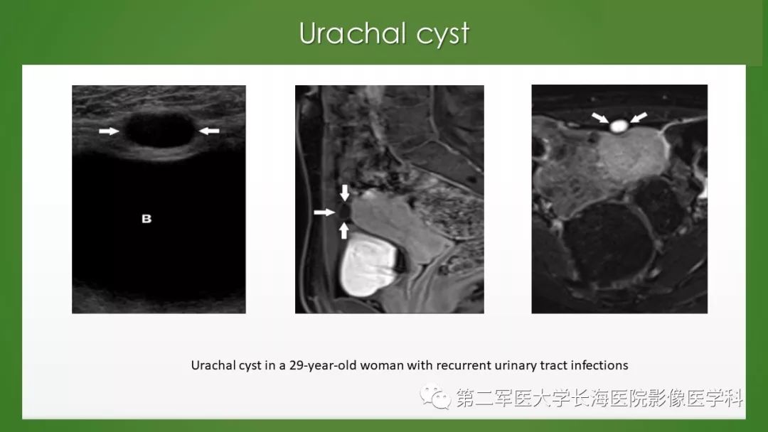 【PPT】脐尿管异常的影像表现与临床